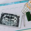 Diş implantı için çekilen bir röntgen filmi