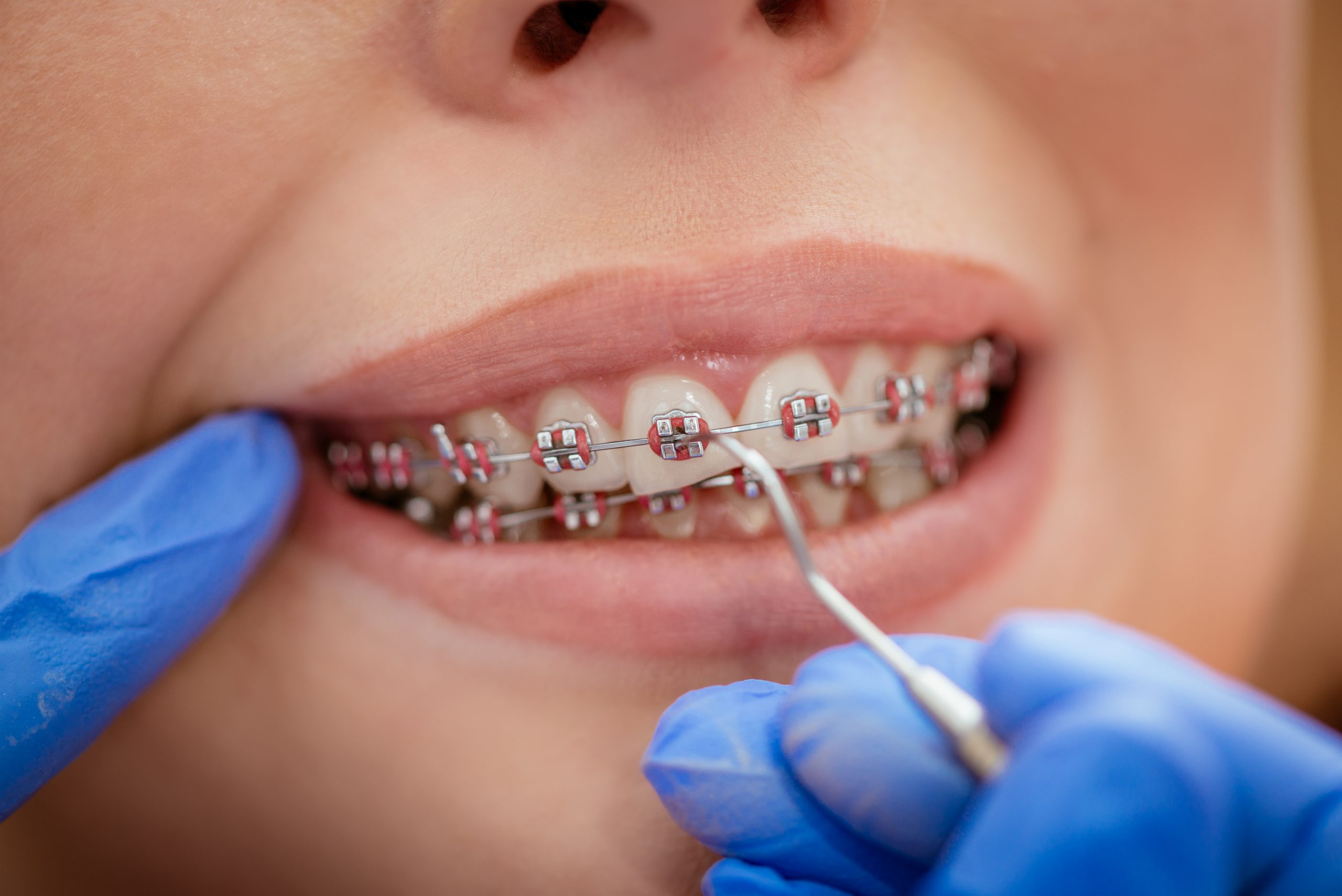 Special care to braces and invisalign