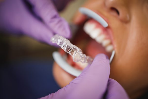Invisalign is quite a popular treatment method