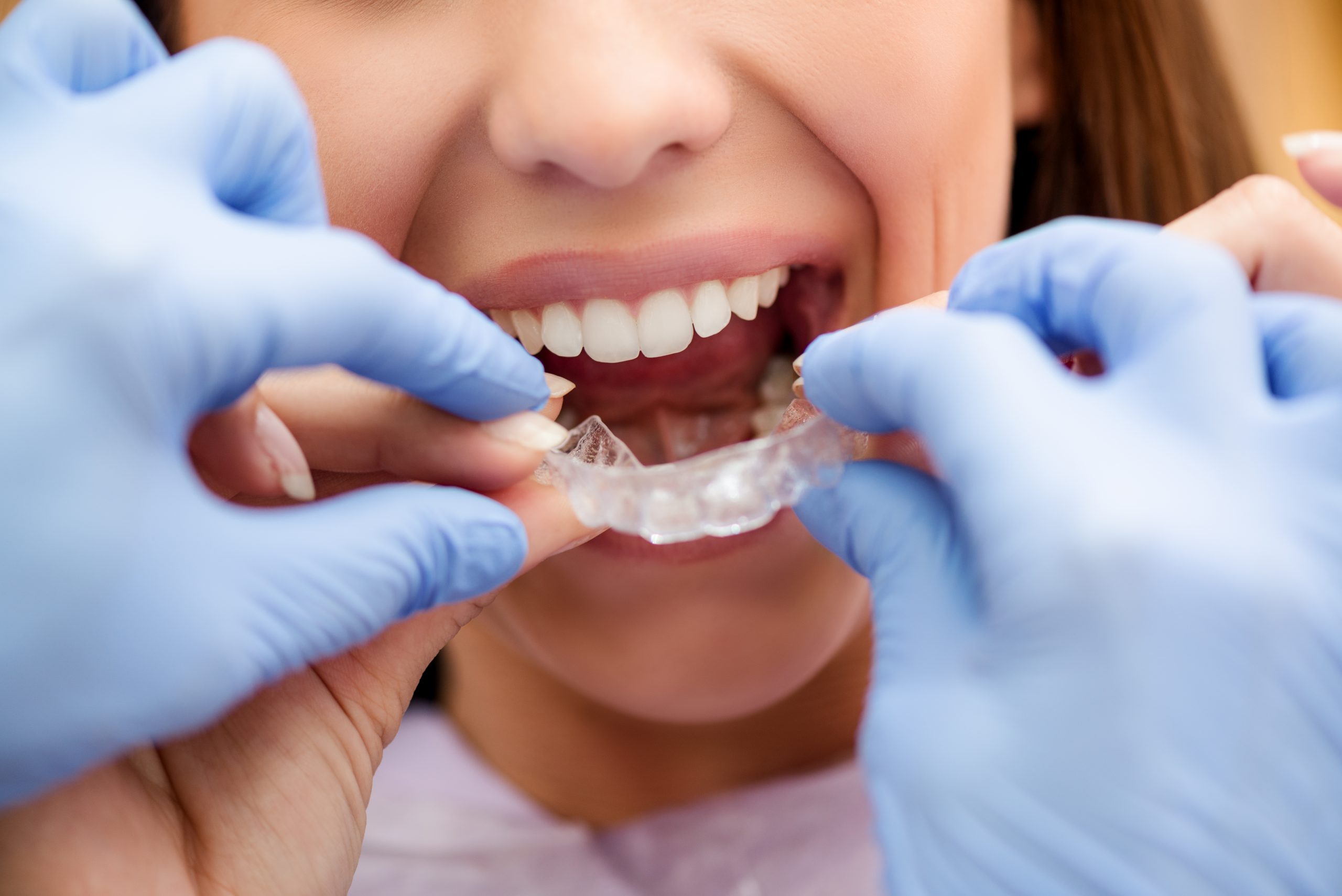 Invisalign on teeth