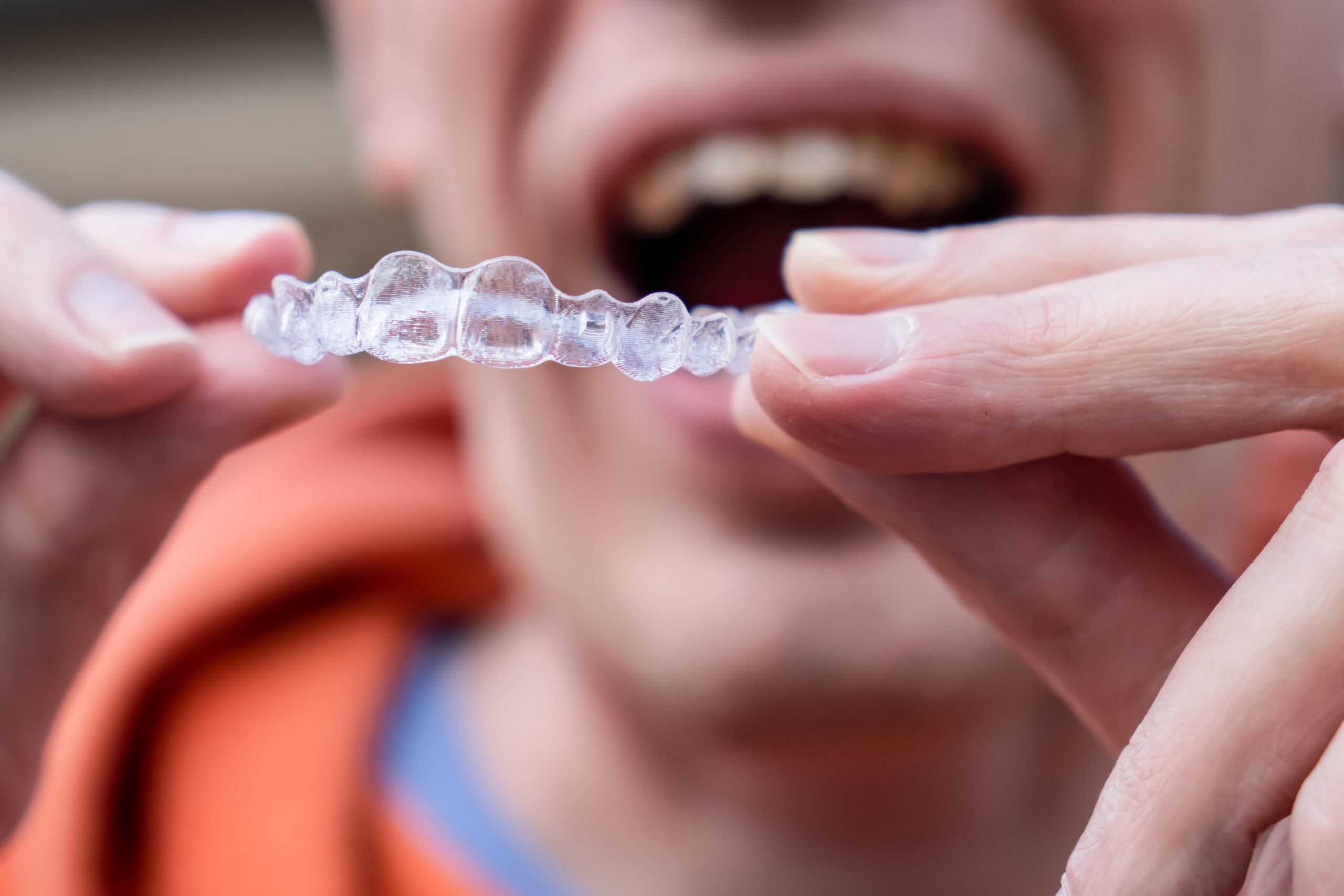 Invisalign, material invisalign is made of