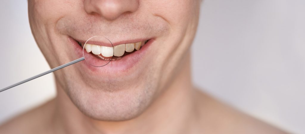 Teeth whitening can improve your smile