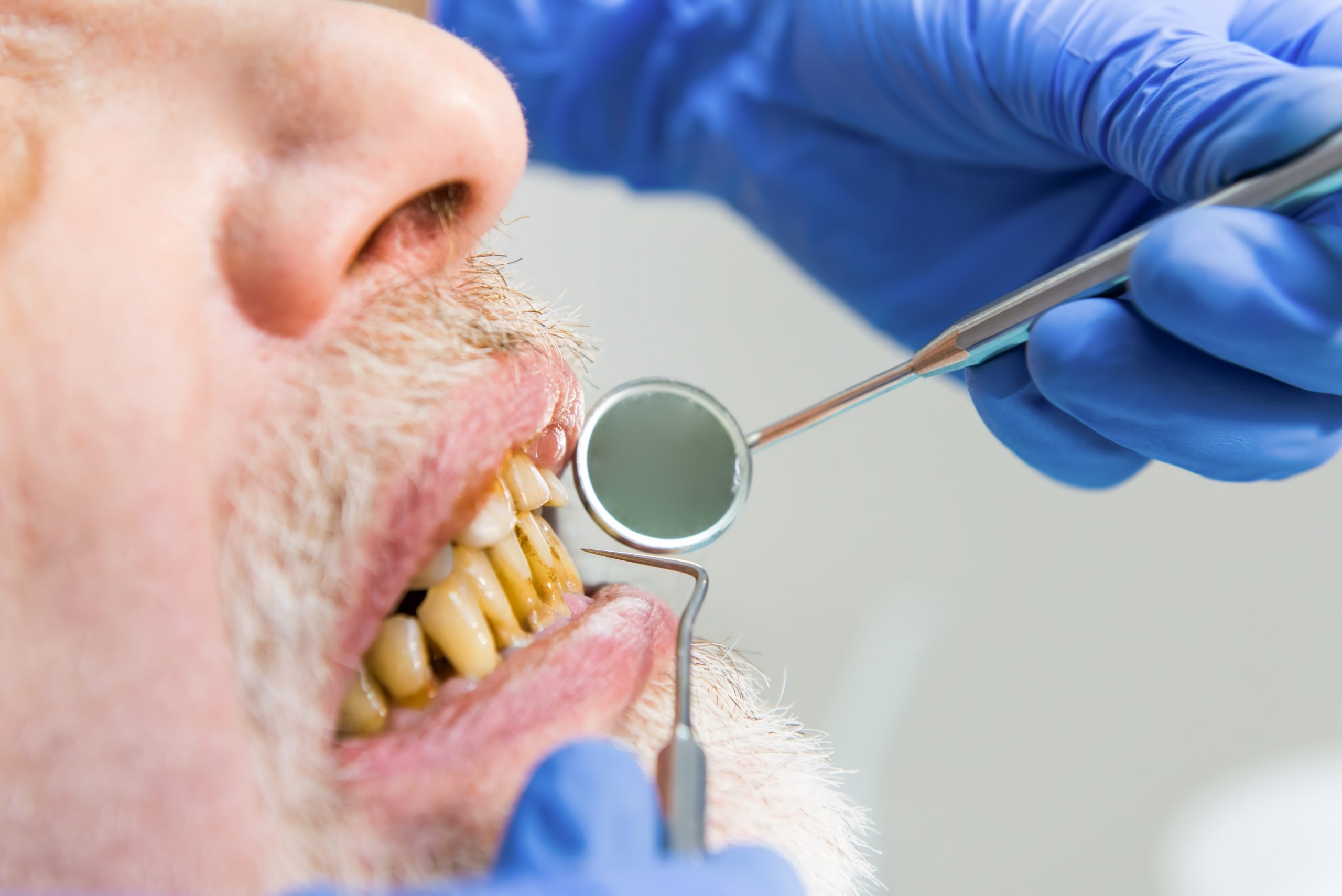 Tooth stain has different reasons