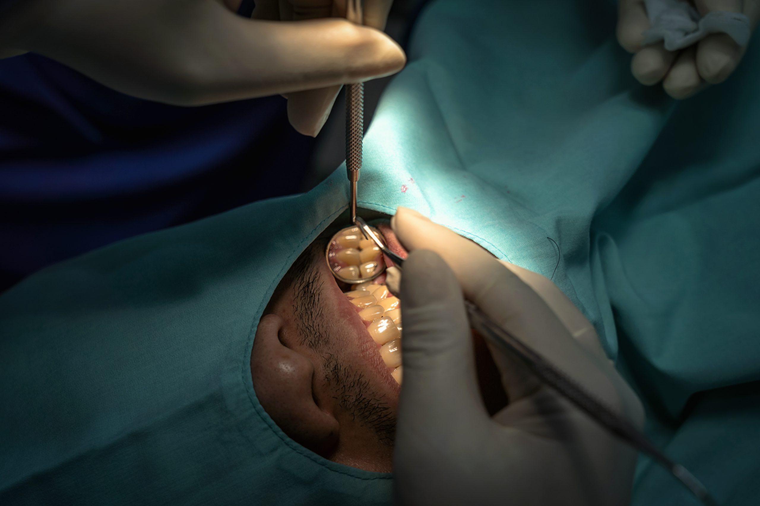 Patient having a dental surgeon under anesthesia to avoid potential gum diseases