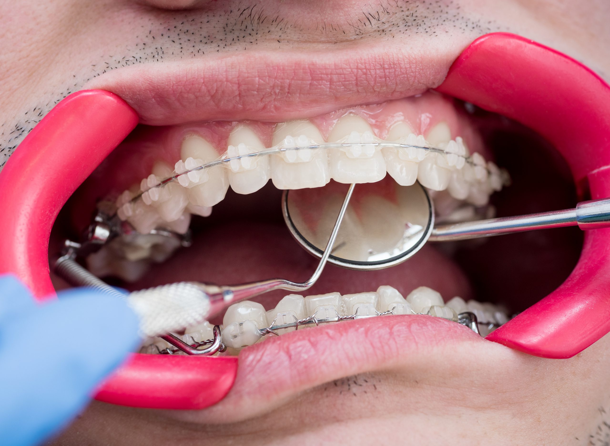Doctor checking out potential gum diseases on patient