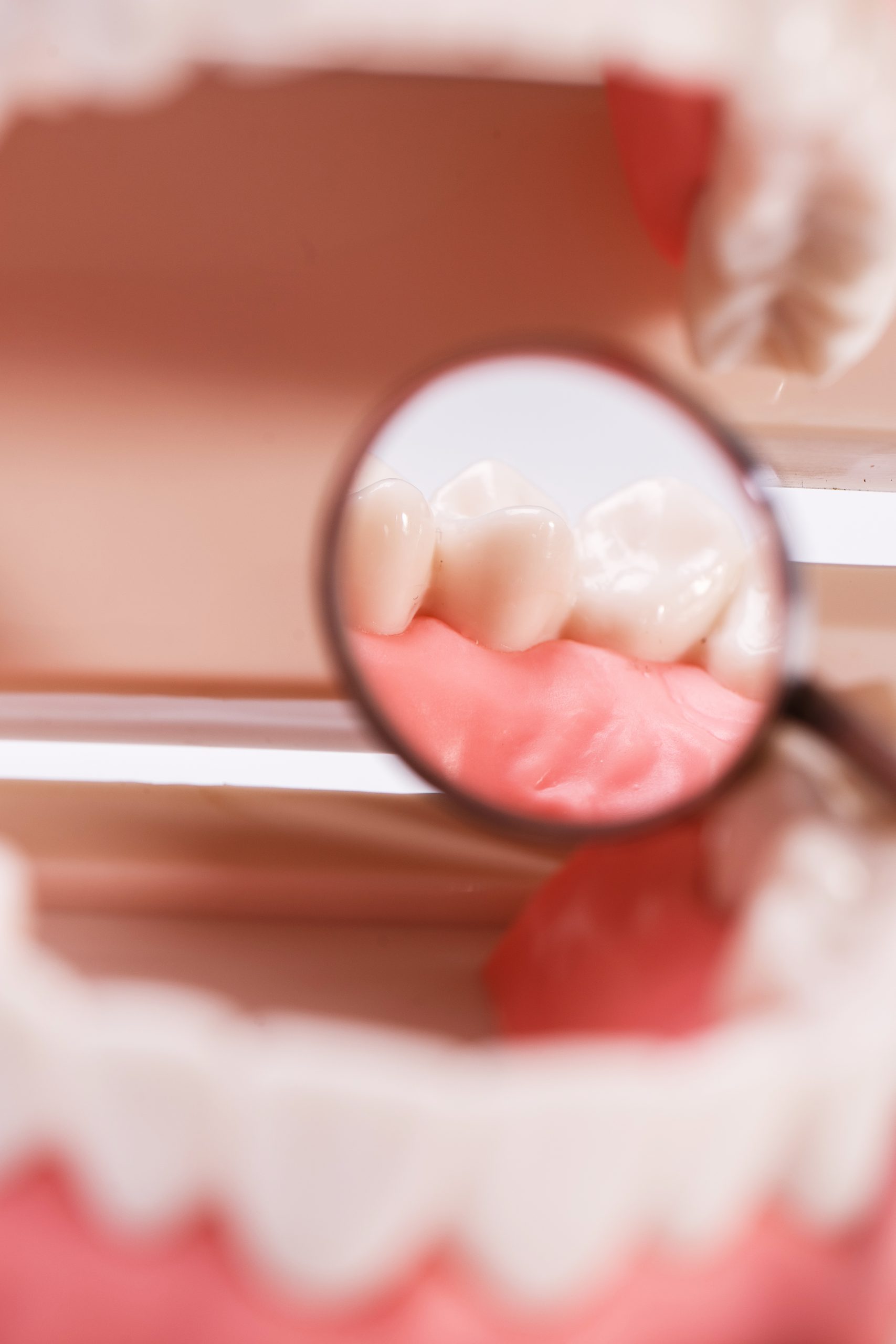 Gum diseases are avoidable with dental check-ups