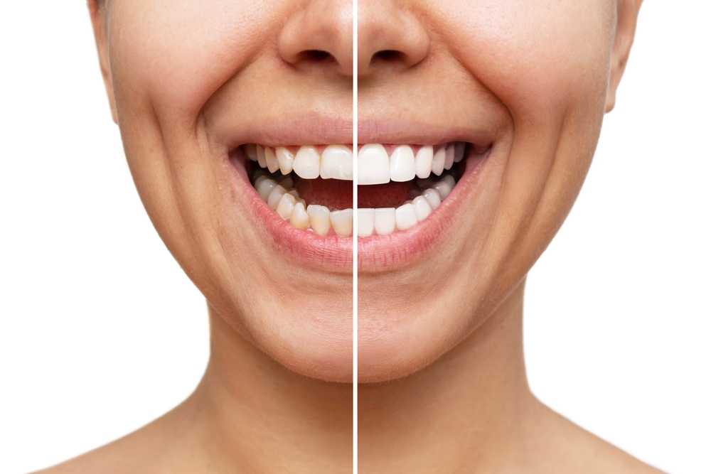 Comparison image showing teeth before and after orthodontic treatment