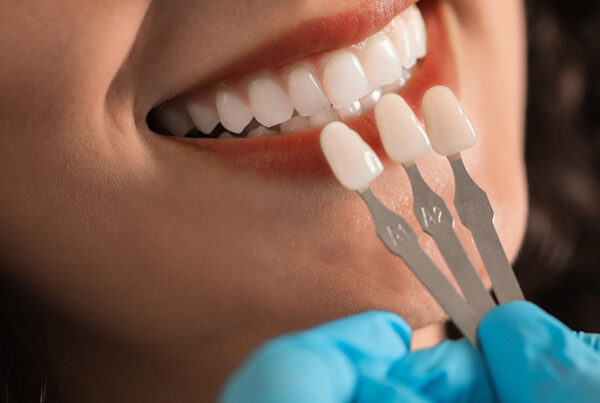 Dentist matching porcelain veneer shades to patient's teeth during cosmetic dental consultation at Natural Clinic