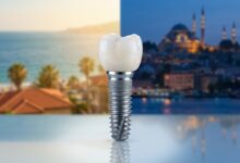 Un implant dentaire de haute technologie en gros plan, sur un fond divisé et flou montrant d'un côté une ville côtière espagnole ensoleillée et de l'autre la ville d'Istanbul au crépuscule, symbolisant le choix pour le tourisme dentaire.