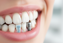 Una vista de primer plano de una boca sonriente con dientes blancos y sanos, donde un diente restaurado con un implante dental se mezcla perfectamente con los demás. Una representación sutil y esquemática de la estructura del implante de titanio es visible bajo la encía, sobre un fondo borroso de clínica dental moderna.