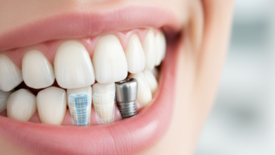 Una vista de primer plano de una boca sonriente con dientes blancos y sanos, donde un diente restaurado con un implante dental se mezcla perfectamente con los demás. Una representación sutil y esquemática de la estructura del implante de titanio es visible bajo la encía, sobre un fondo borroso de clínica dental moderna.