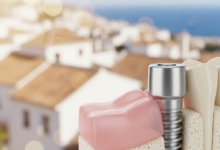 Primer plano fotorealista de un brillante implante dental de titanio insertado en una estructura estilizada de hueso y encía, con un fondo suavemente desenfocado que sugiere un paisaje costero soleado de España.