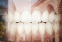 Una imagen conceptual que compara el turismo dental en España y Turquía, con un diente blanco estilizado en primer plano y fondos borrosos que representan sutilmente la arquitectura europea (izquierda) y turca (derecha).