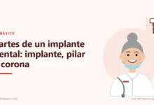 Ilustración: Partes de un implante dental: implante, pilar y corona